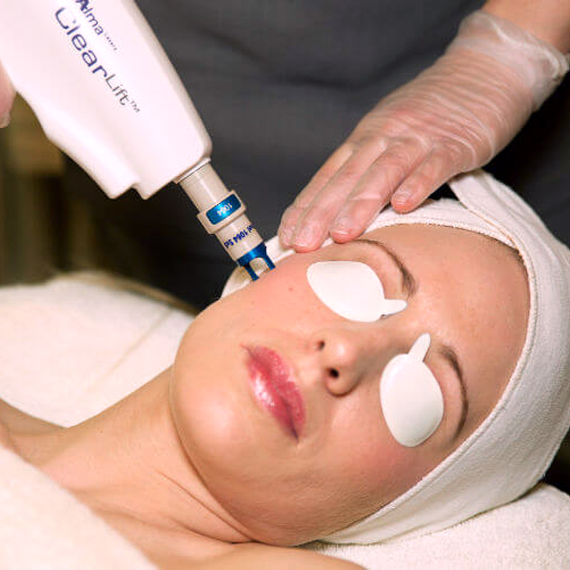 takes years off of your face, Clearlift laser, 