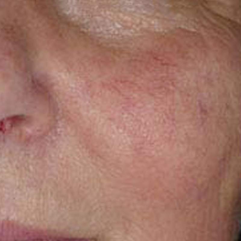 IPL for Vessels, unsightly surface blood vessels, removing cherry angiomas