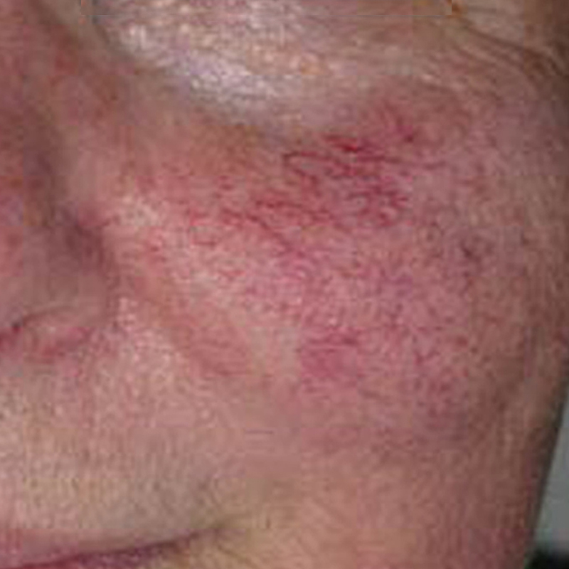 IPL for Vessels, unsightly surface blood vessels, removing cherry angiomas