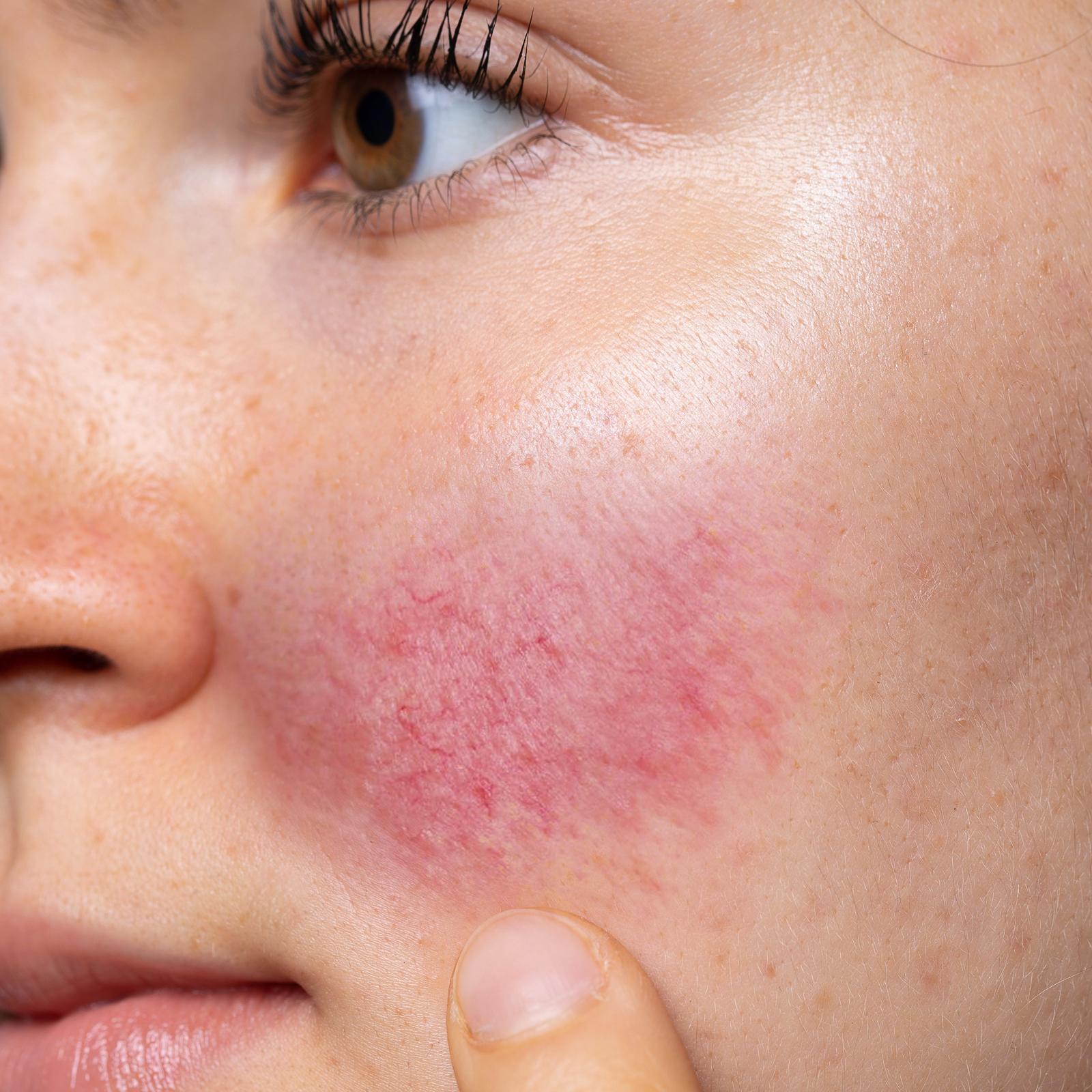 Rosacea Flare-up Education, Rosacea Management