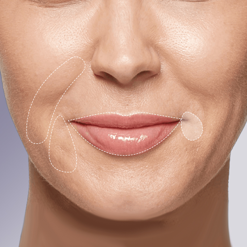 dermal fillers, lip filler