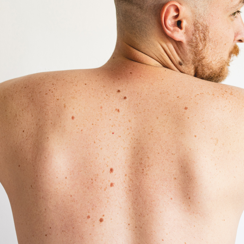 Skin Cancer, Mole Checks, dermoscopy