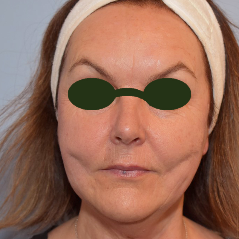 Koru Clinic MINT NonSurgical Thread Lift